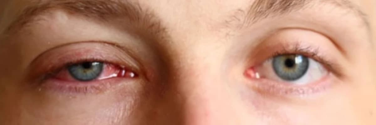 Allergik rinokonyuktivit