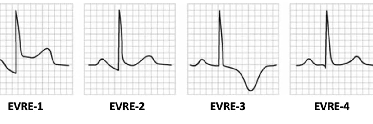 Elektrofiziologiya, EECP Müalicəsi, Perikardit Müalicəsi