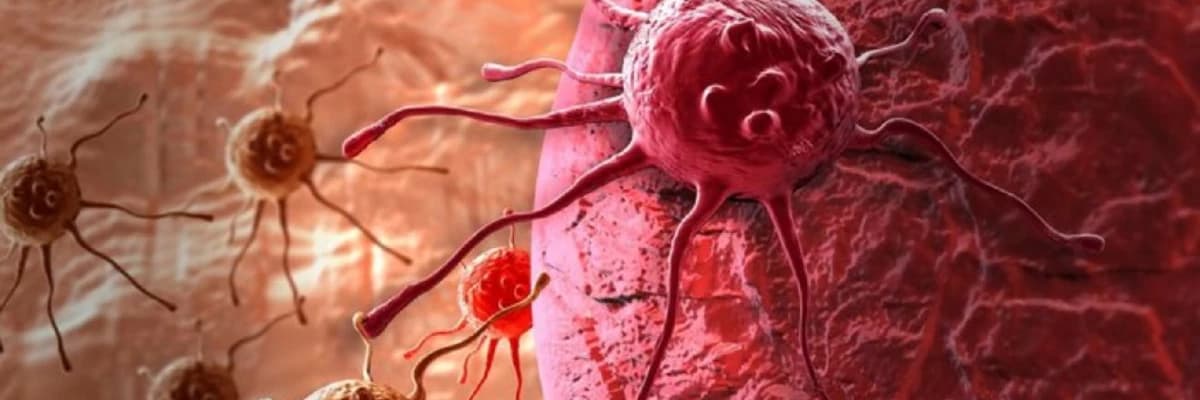 Öd kisəsin bəd xassəli şişi