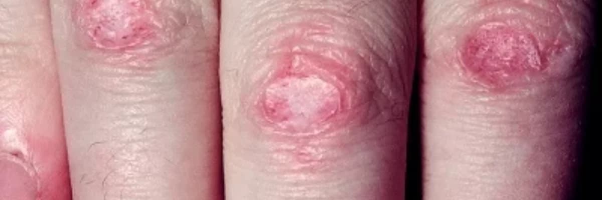 Polimiozit/dermatomiozit haqqında