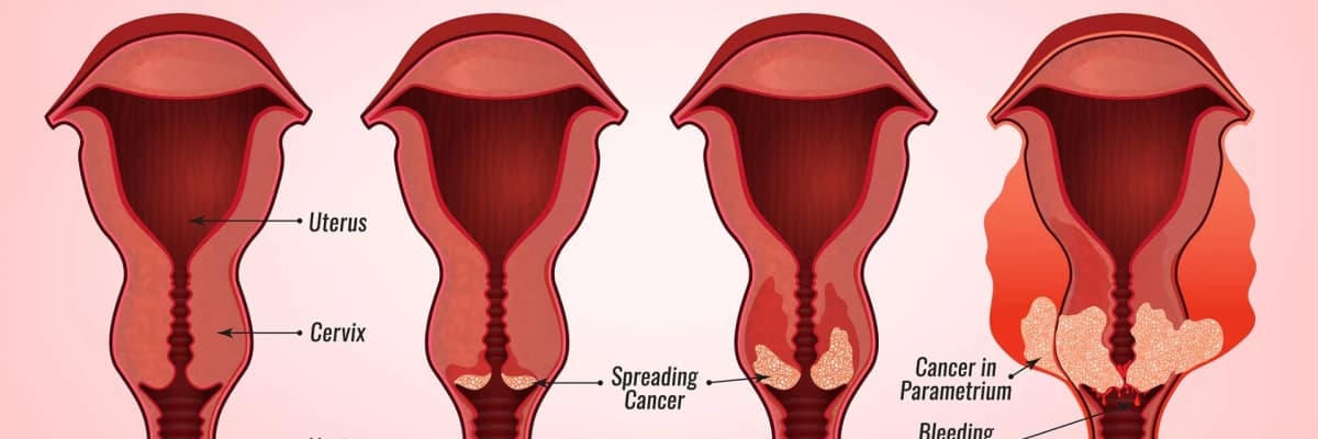 Uterus xərçəngi: səbəbləri, simptomları və müalicəsi