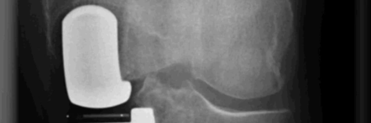 ARTROPLASTIKA