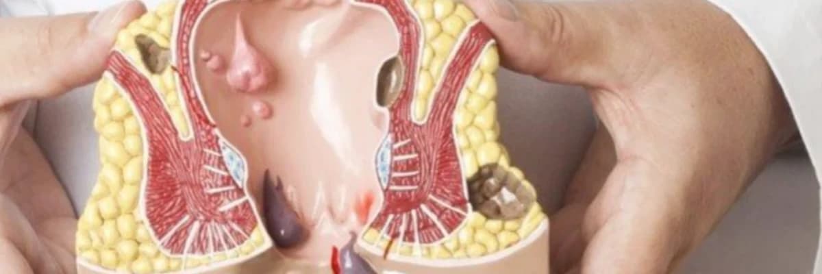 Anal Nahiyə Xəstəlikləri: Diaqnoz, Simptomlar və Müalicə