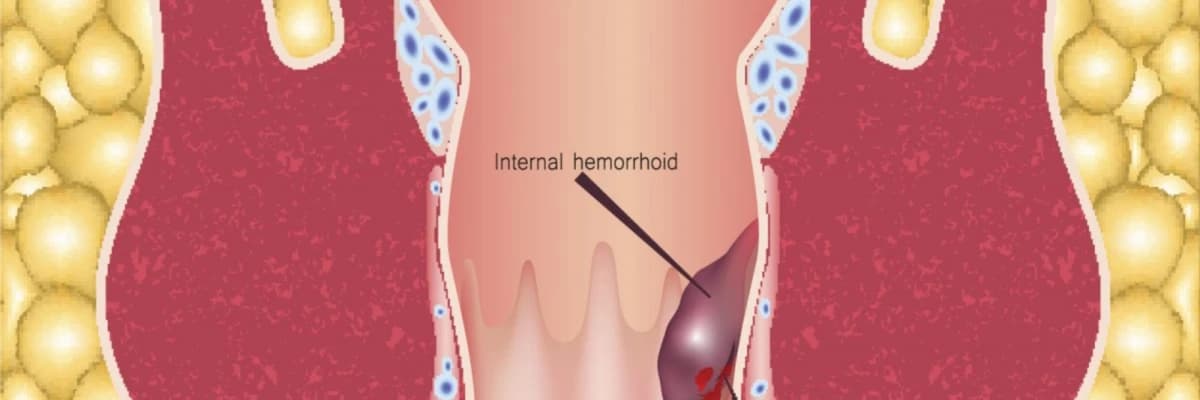 Hemoroid nədir?