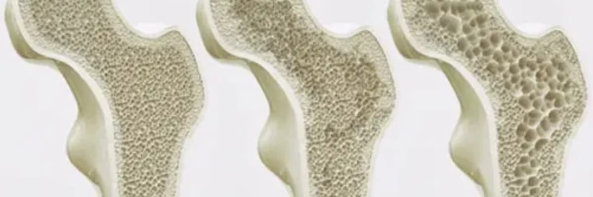 Osteoporoz haqqında