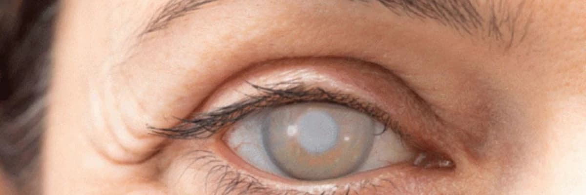 Katarakt Cərrahiyyəsi haqqında