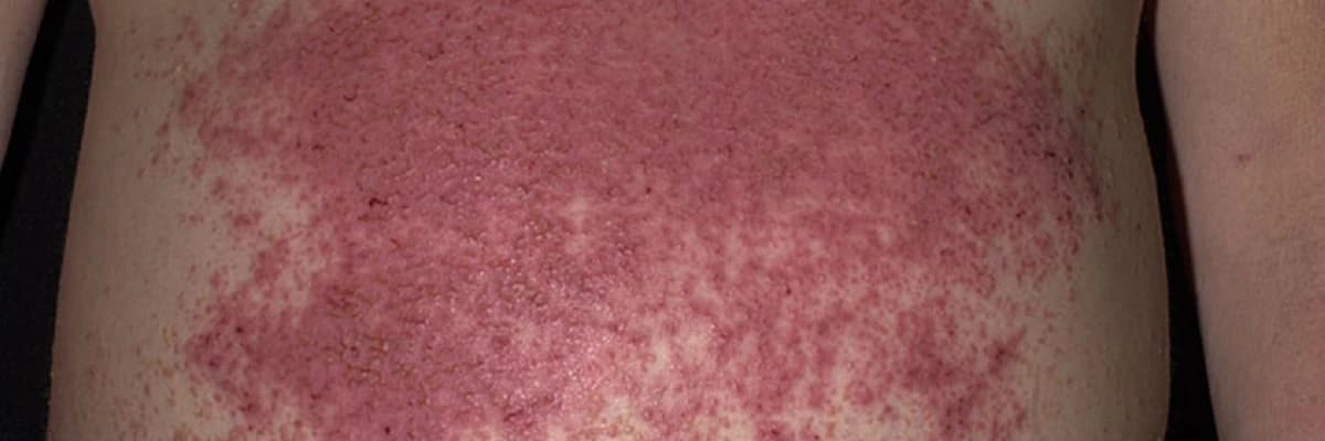 Dermatitis Herpetiformis