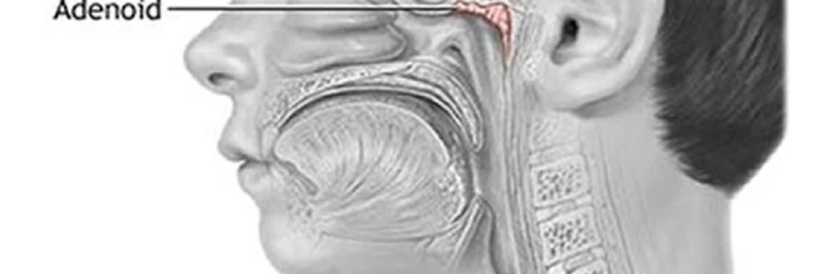 Adenoidektomiya