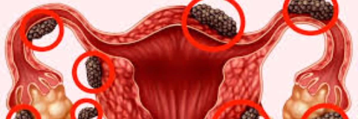 Endometrioz