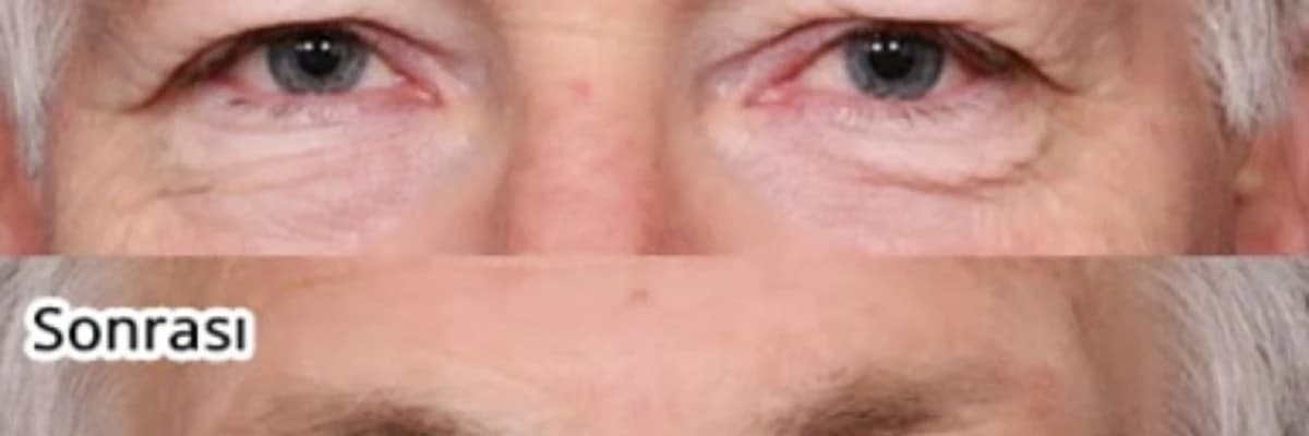 Göz qapaqlarının estetikası və post-estetika