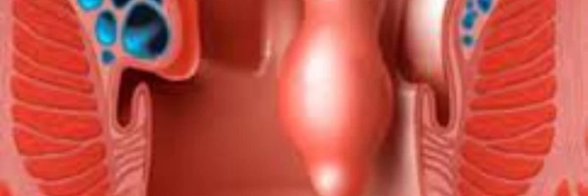 Duz bagirsagin endometriozu