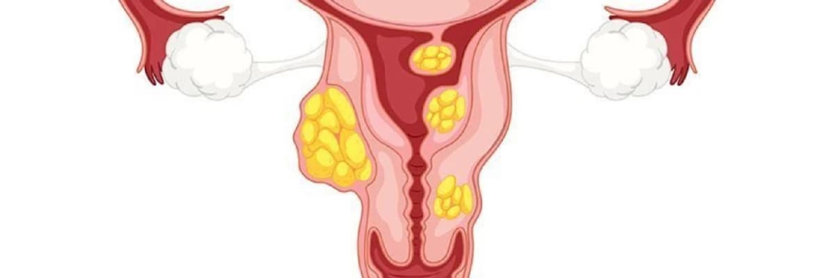Iltihabi xəstəliklər (Endometrit, Salpingit, Ooforit, Kolpit ( vaginit), Servisit, Bartolinit, Vulvit)