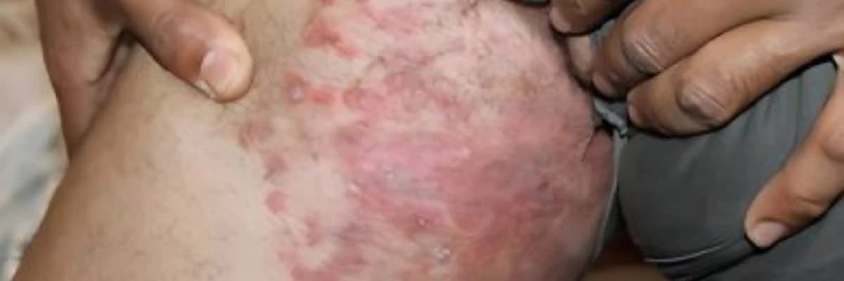 Göbələk xəstəlikləri