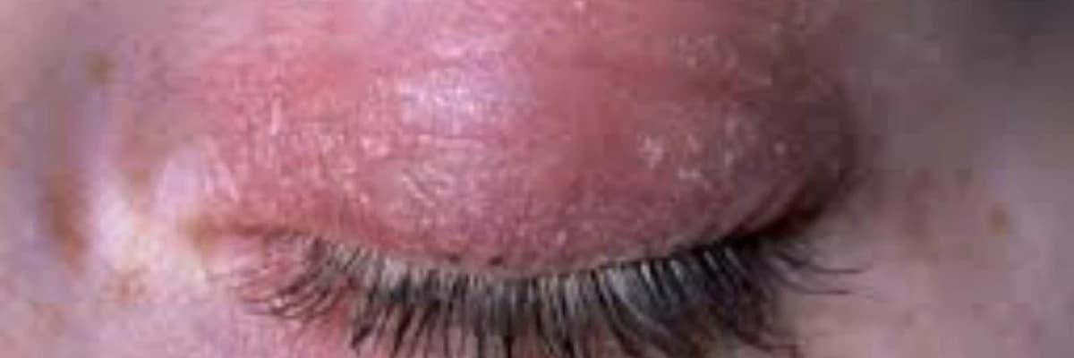 Göz qapaqlarının pozulması