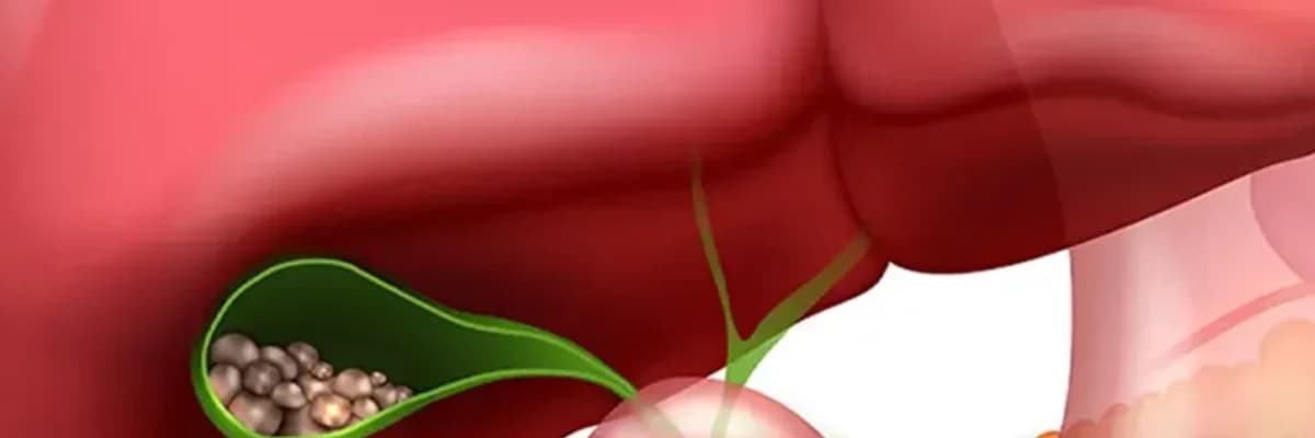 Öd kisəsi daşları