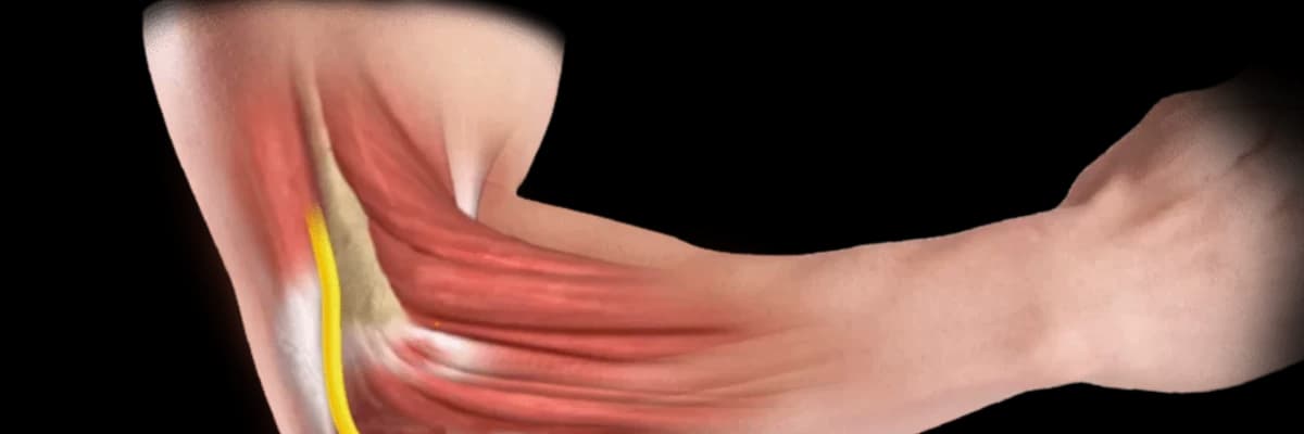 Kubital tunel sindromu