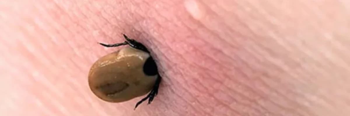 Lyme xəstəliyi: simptomlar, diaqnoz və müalicə