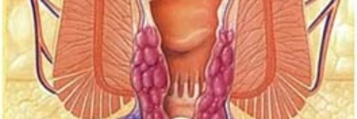 Anal tromboz