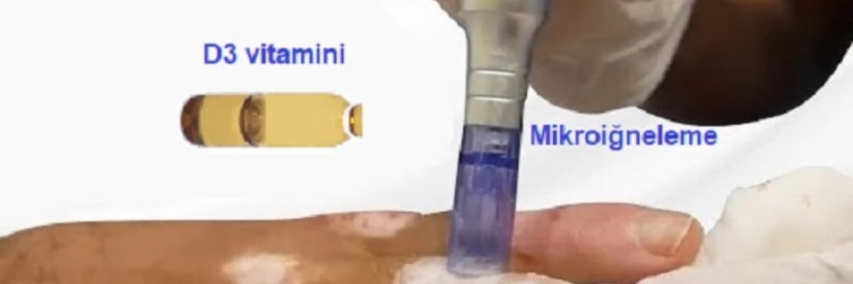 Vitiligo üçün Mikronidling və Vitamin D Müalicələri: Yanaşmalar və Potensial Faydalar