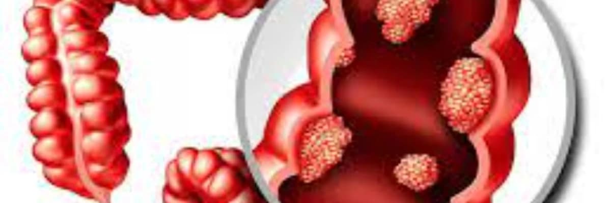 Yogun bagirsaq xercengi