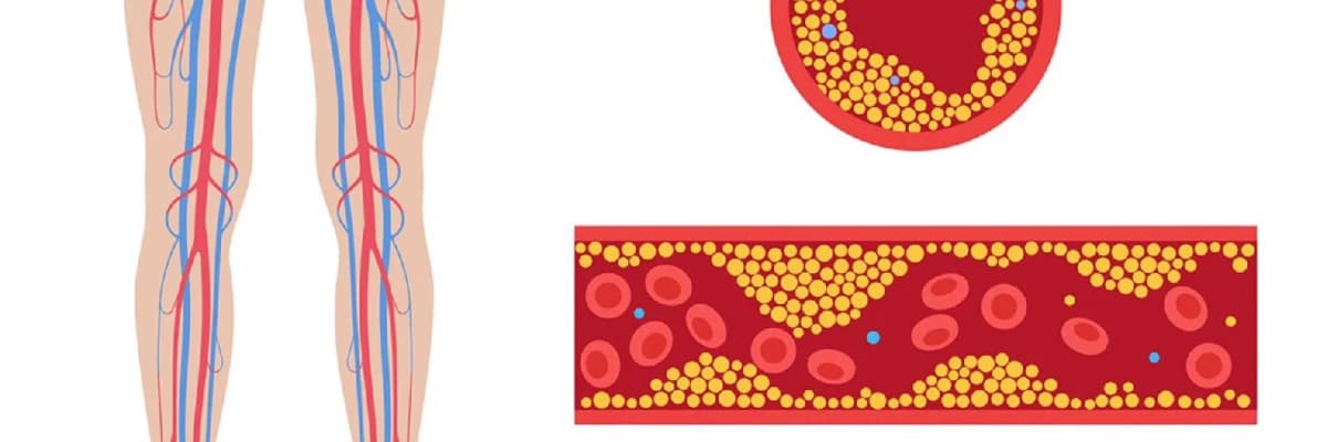 Periferik arteriya xəstəliyi: Ayaqlarda qan dövranı problemləri