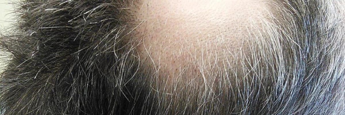 Ocaqlı alopesiyalar