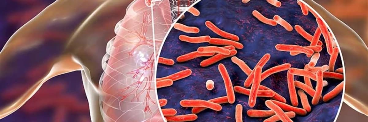 Vərəm: Tarixdən indiyə kimi bir sağlamlıq problemi