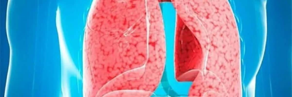 Ağciyər İnfeksiyası (Pnevmoniya):