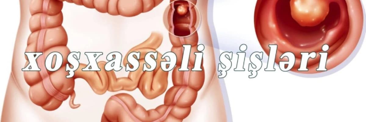 yogun bagirsagin xosxasseli sisleri