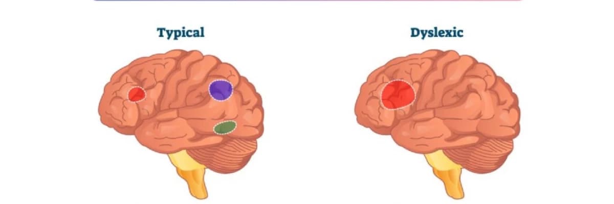 Disleksiya Növləri, Əlamətləri və Müalicə Üsulları