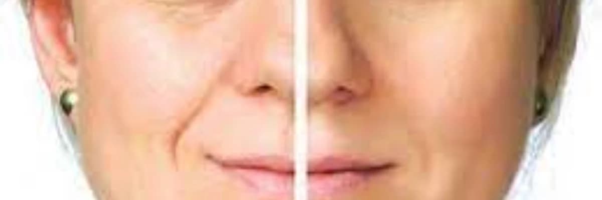 Dodağın Yuxarı Qalxdırılması Estetikası
