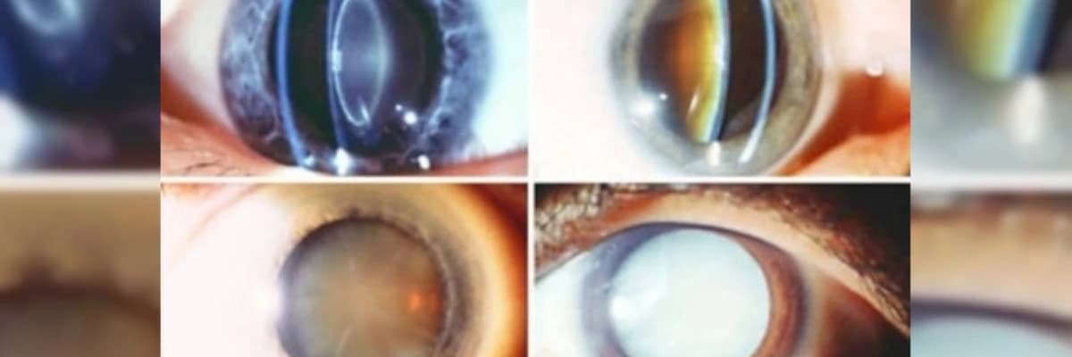 Katarakta xəstəliyi, diaqnoz və müalicə üsulları