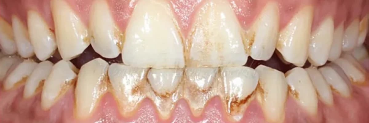 Diş Əti Xəstəlikləri: Səbəblər, Simptomlar və Qorunma Yolları