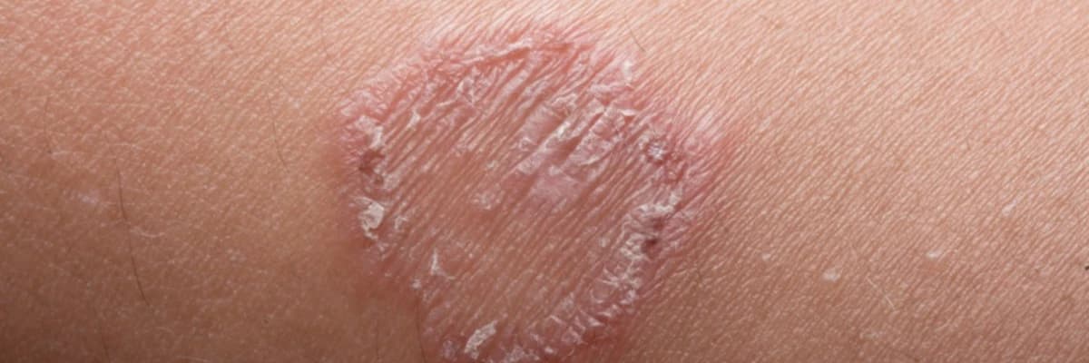 Maya infeksiyası: səbəbləri, simptomları və müalicələri sağlamlığınız üçün vacib məlumatlardır