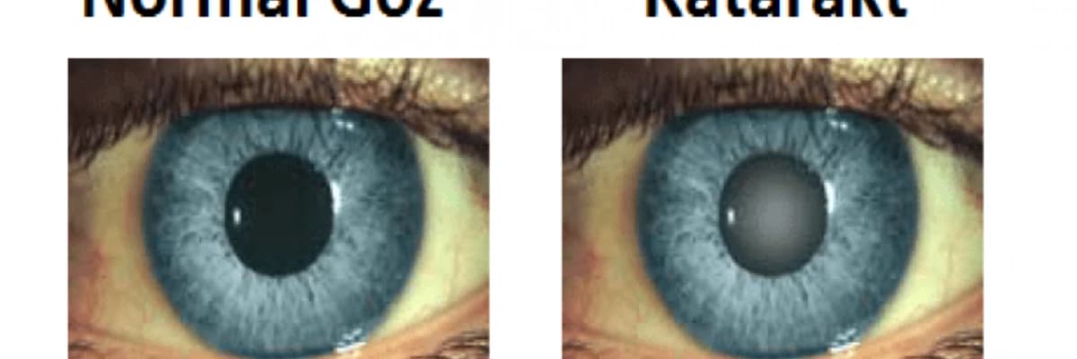 Katarakt əməliyyatının müvəffəqiyyət nisbəti necədir?