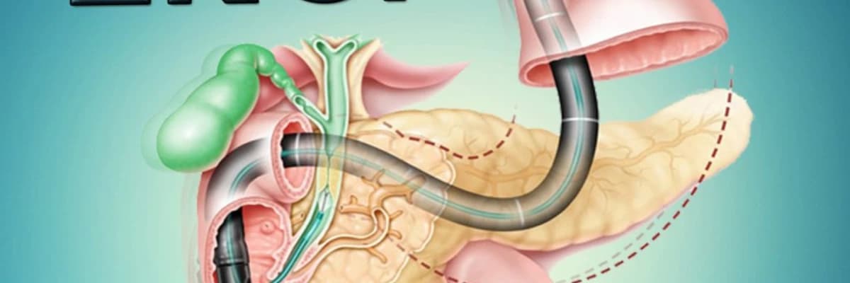 Ercp nədir, kimə tətbiq olunur?