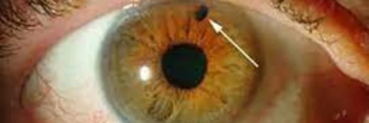 Qlaukomanın (Qara su) müalicəsi