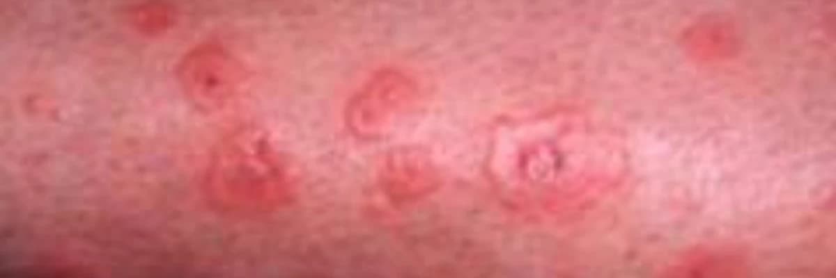 Perianal Ekzema: Səbəbləri, Simptomları və Müalicə Yolları