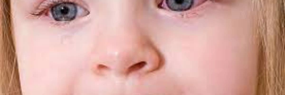 Allergik konyunktivit