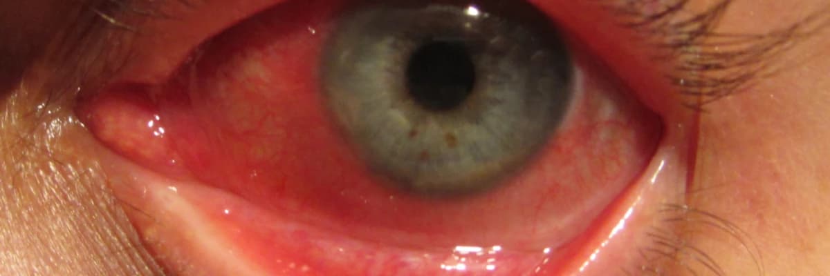 Konyunktivit: səbəbləri, simptomları və müalicəsi