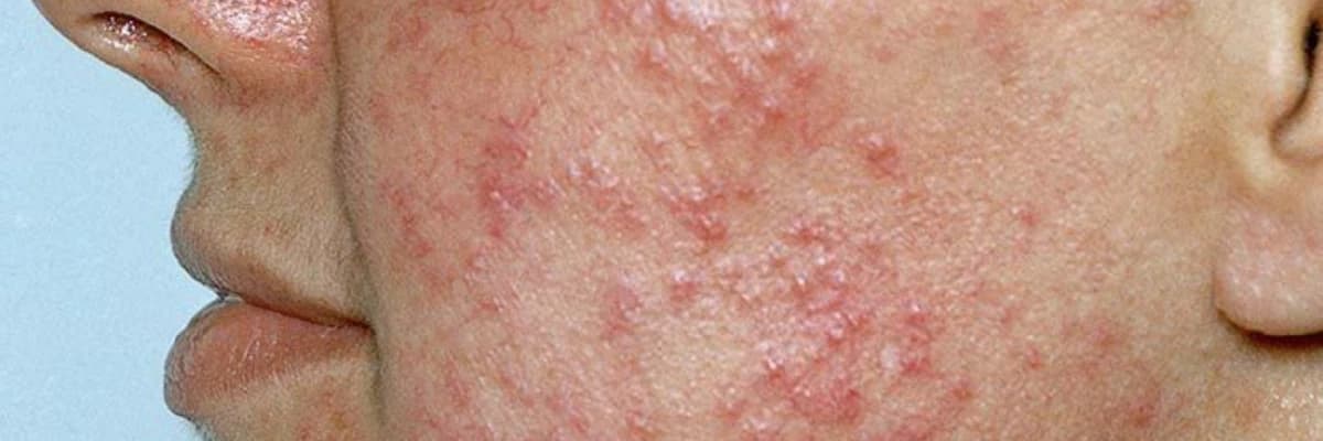 ROZASEA (Qızılgül) Xəstəliyi