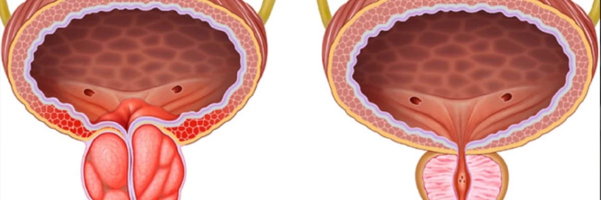 Üretranın daralması