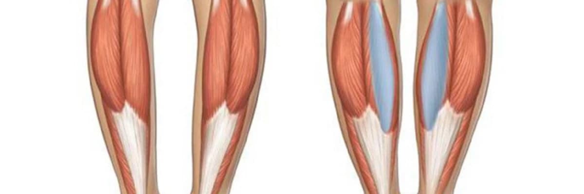 Bud Estetikası (Implant ve Piy): Güclü və Estetik Ayaqlar üçün İnnovativ Həll