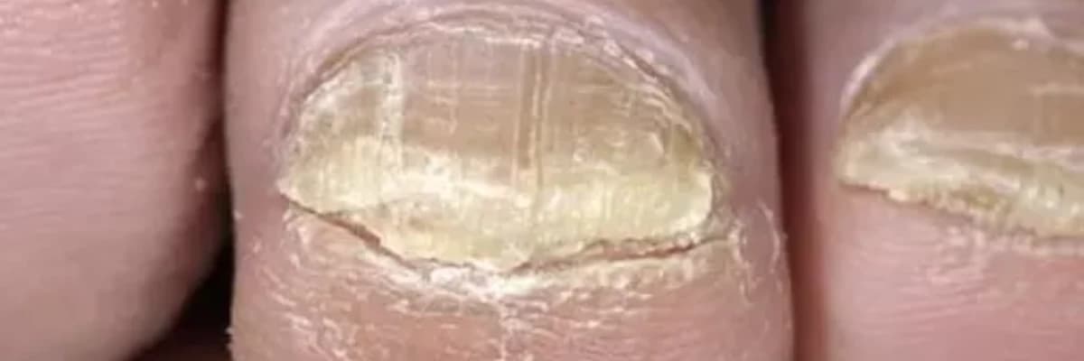 Dırnaq Xəstəlikləri: Səbəbləri, Təzahürləri və Müalicə Metodları