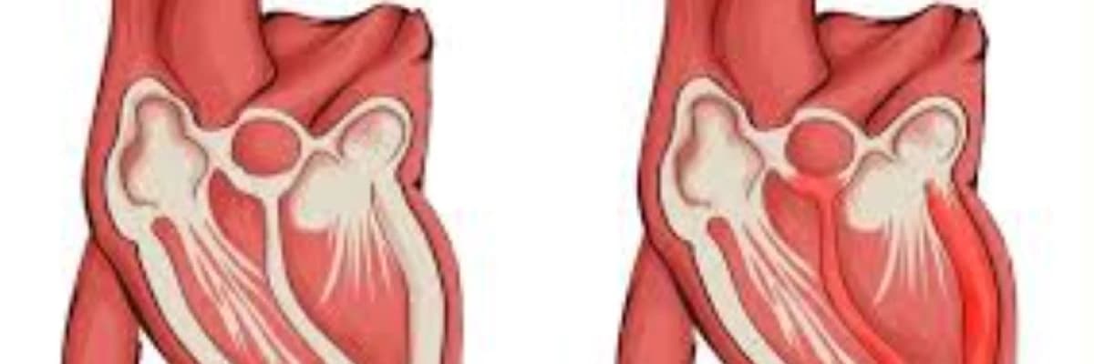 İnfeksion allergik miokardit