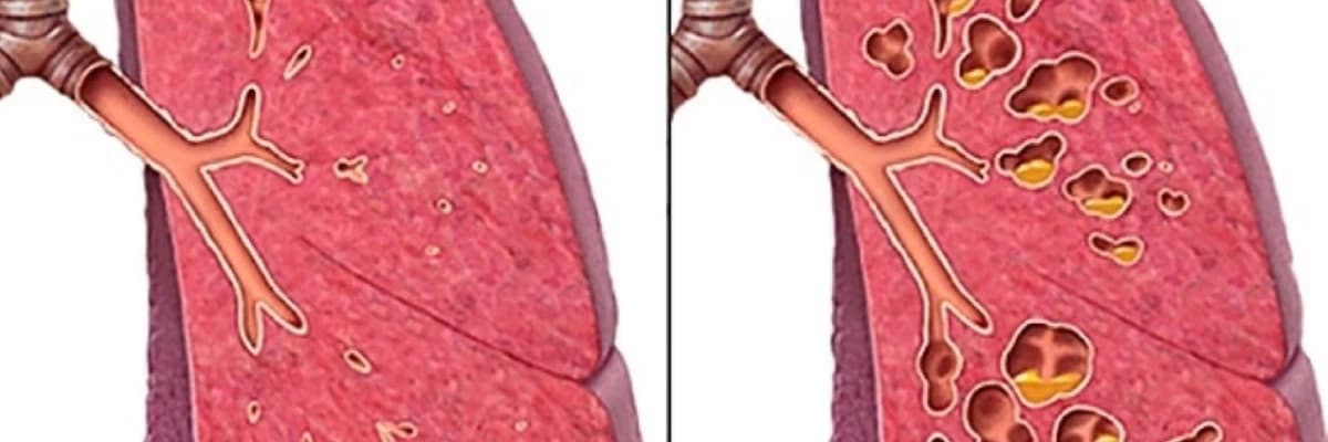 Kistik fibroz- bronxopulmoner sistemin xarici ifrazat genetik olaraq təyin olunmuş vəzlərin patologiyası