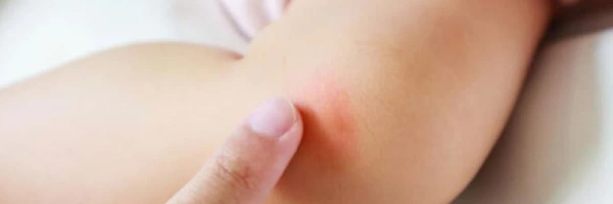 Qida allergiyasının simptomları