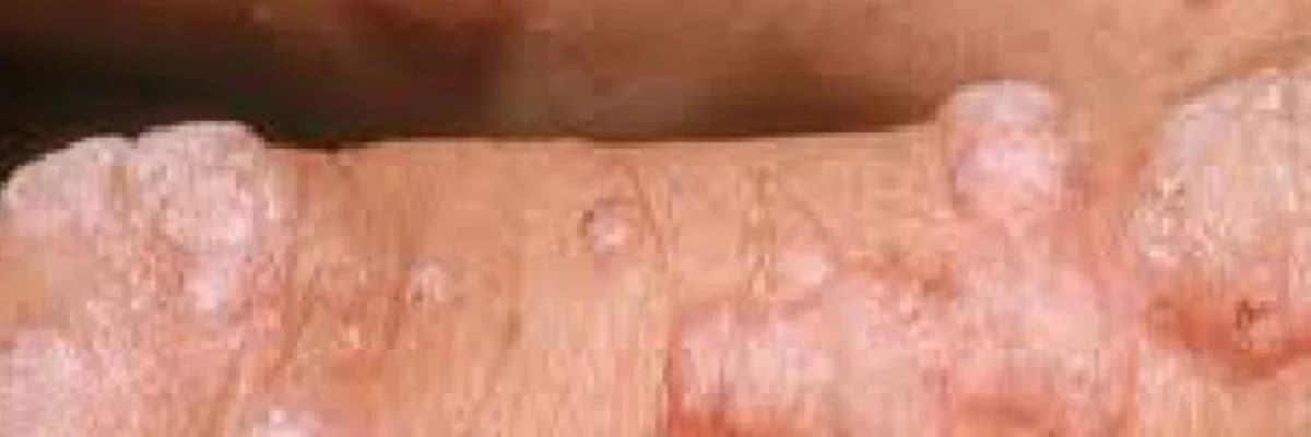 Aşkar edilmiş yüksək onkogen HPV növləri