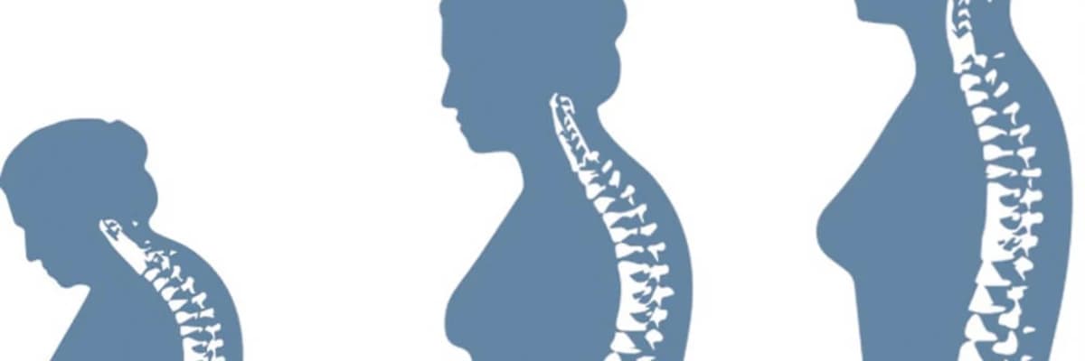 Osteoporoz: səbəbləri, simptomları və müalicəsi