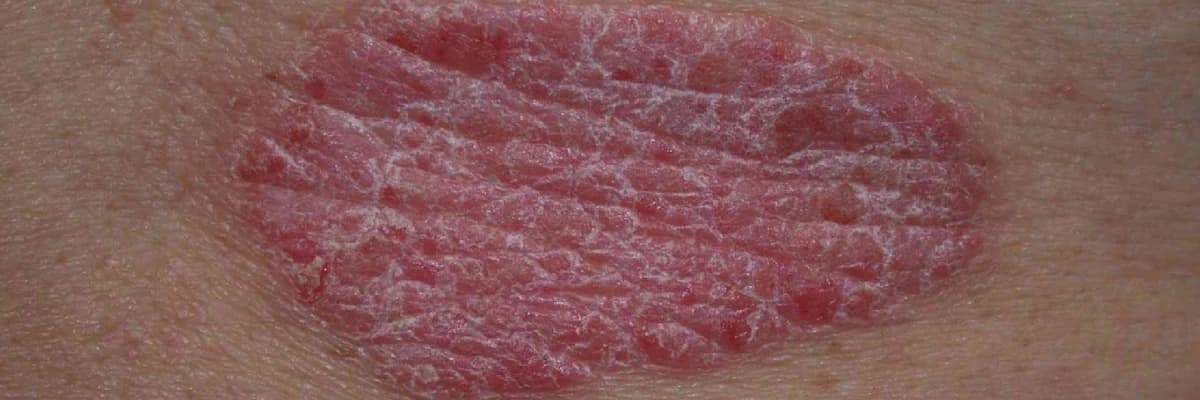 Psoriasis haqqında